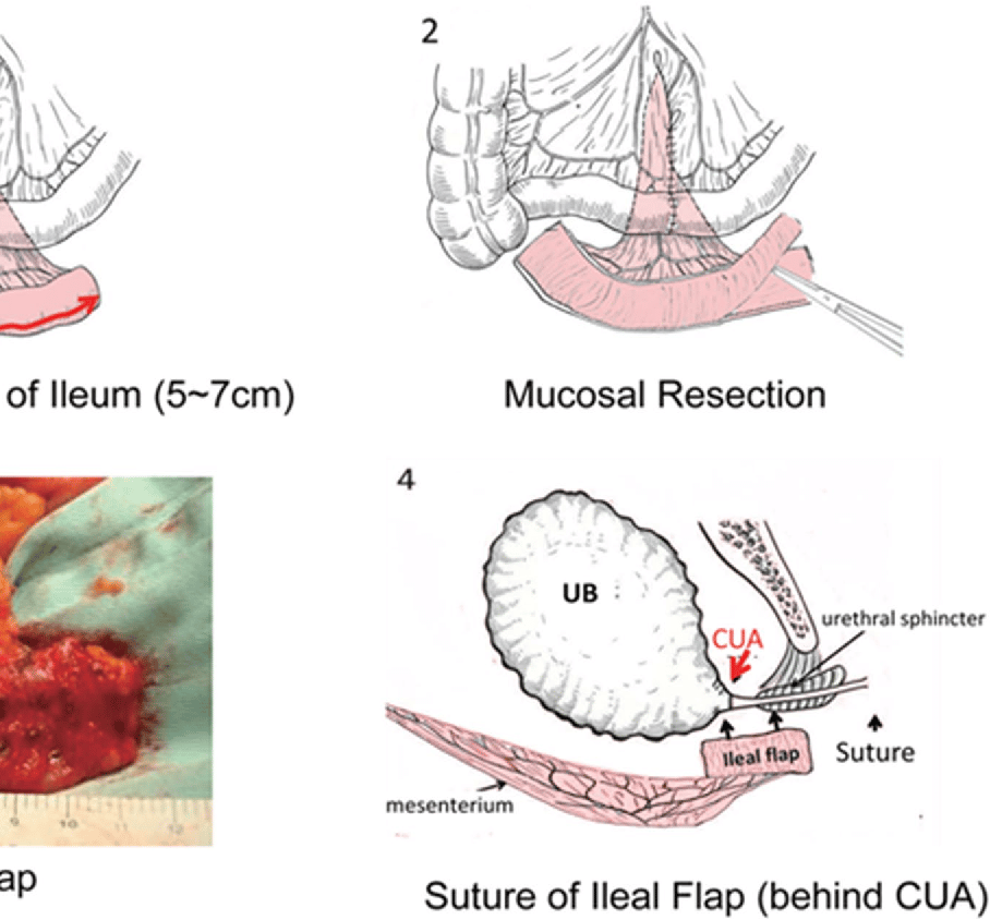 Figure 1 from Efficacy of an additional flap operation in bladder ...