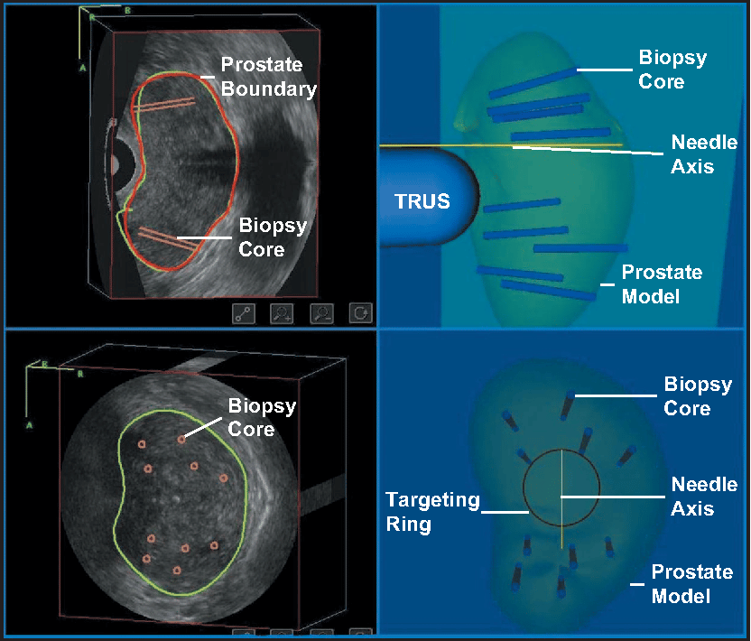 Figure 5 from Mechanically assisted 3D ultrasound guided prostate ...