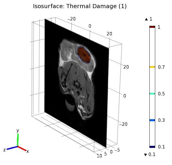 Focal Laser Ablation of Prostate Cancer: Numerical Simulation of ...