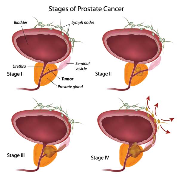 Foods To Avoid After Prostate Surgery