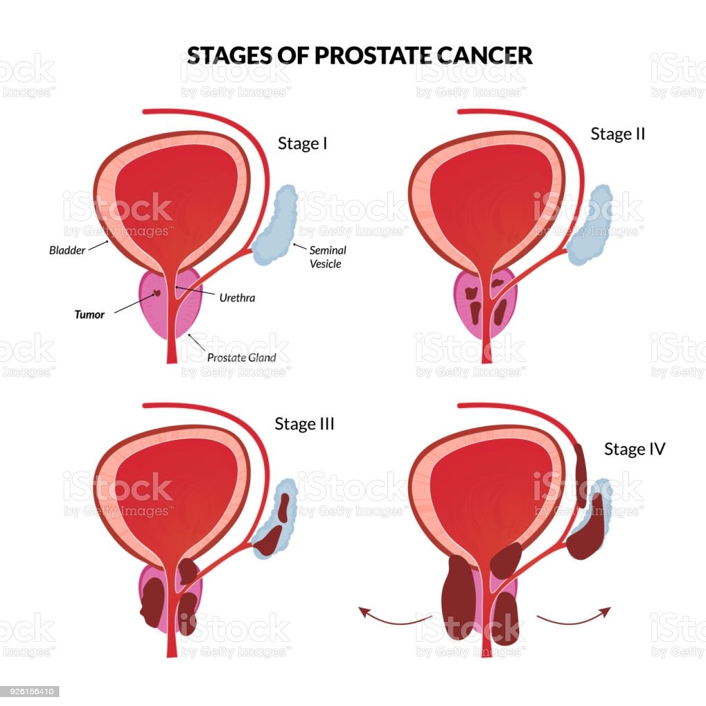 Four Stages Of Prostate Cancer Stock Illustration ...