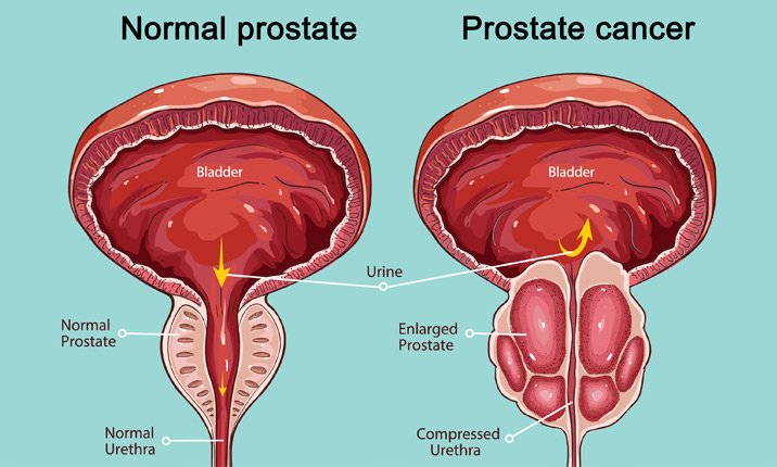 Full text: prostate health awareness lecture by Dr. David ...