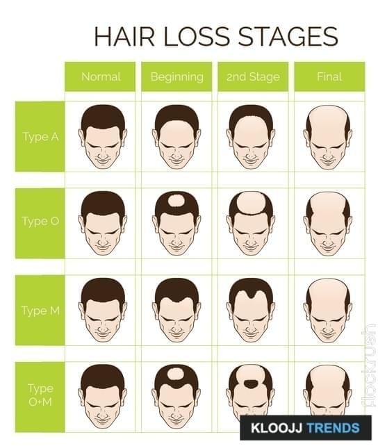 Hair Loss and Causes in Men