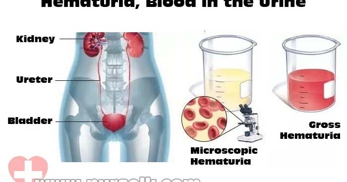 Hematuria, Blood in the Urine