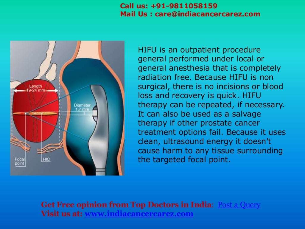 HIFU procedure for Prostate Cancer Treatment