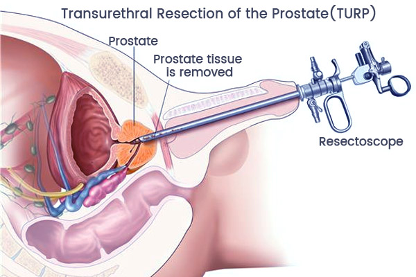 HOLAP/TURP (Holmium Laser Prostatectomy) in Punjab, India
