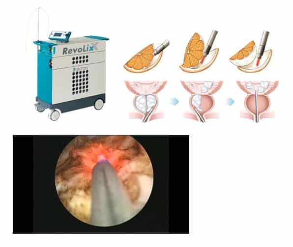 Holmium Laser Enucleation of the Prostate Procedure in Chennai