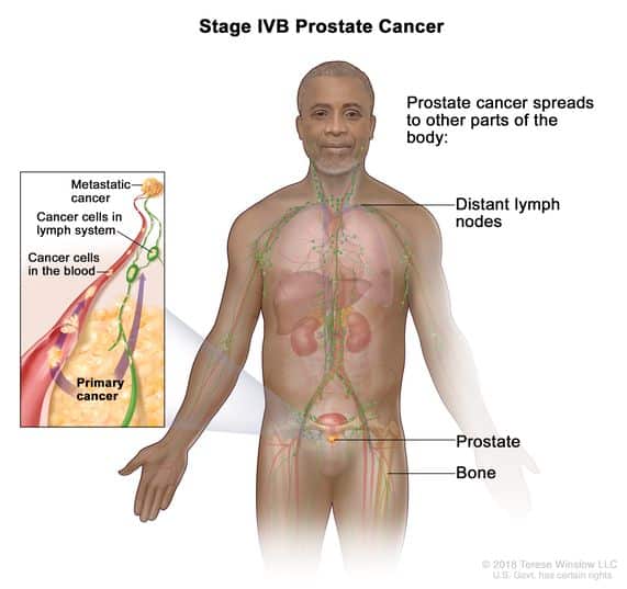 How Do I Know If My Prostate Cancer Has Spread : Prostate Cancer Stages ...