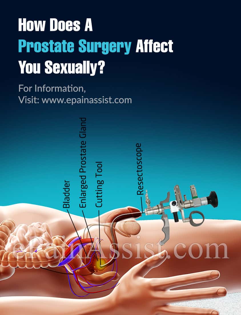 How Does A Prostate Surgery Affect You Sexually?