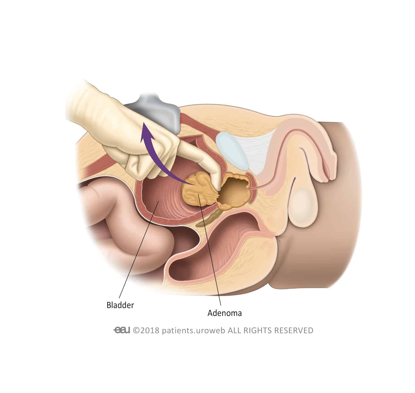 How Is Prostate Surgery Performed
