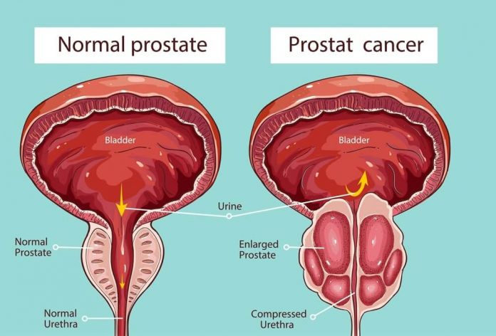 How Long After Prostate Surgery Does Impotence Last ...