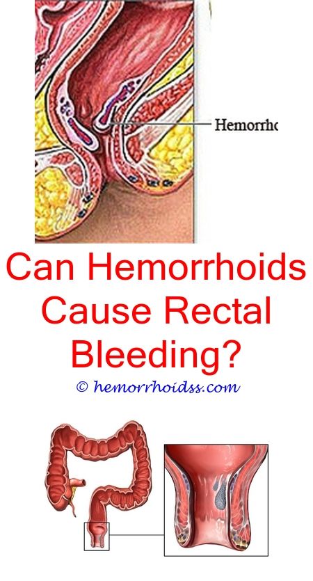 How Long Do Hemorrhoids Last With Preparation H ...