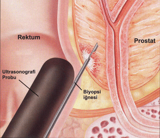 How Long Does Prostate Biopsy Take