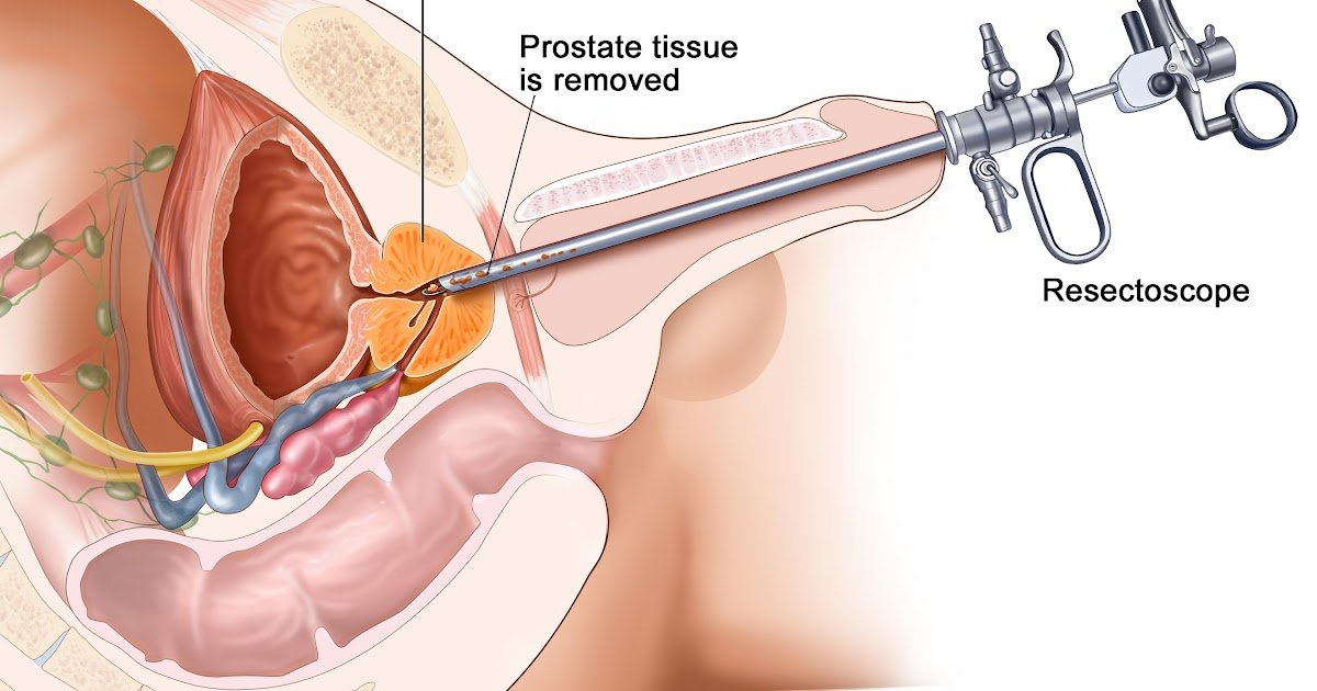 How To Get Rid Of Prostate Cancer