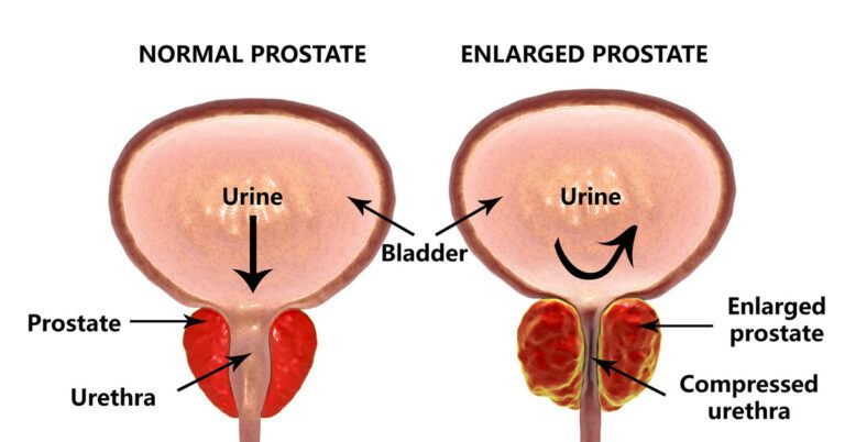 How To Improve Prostate Health.