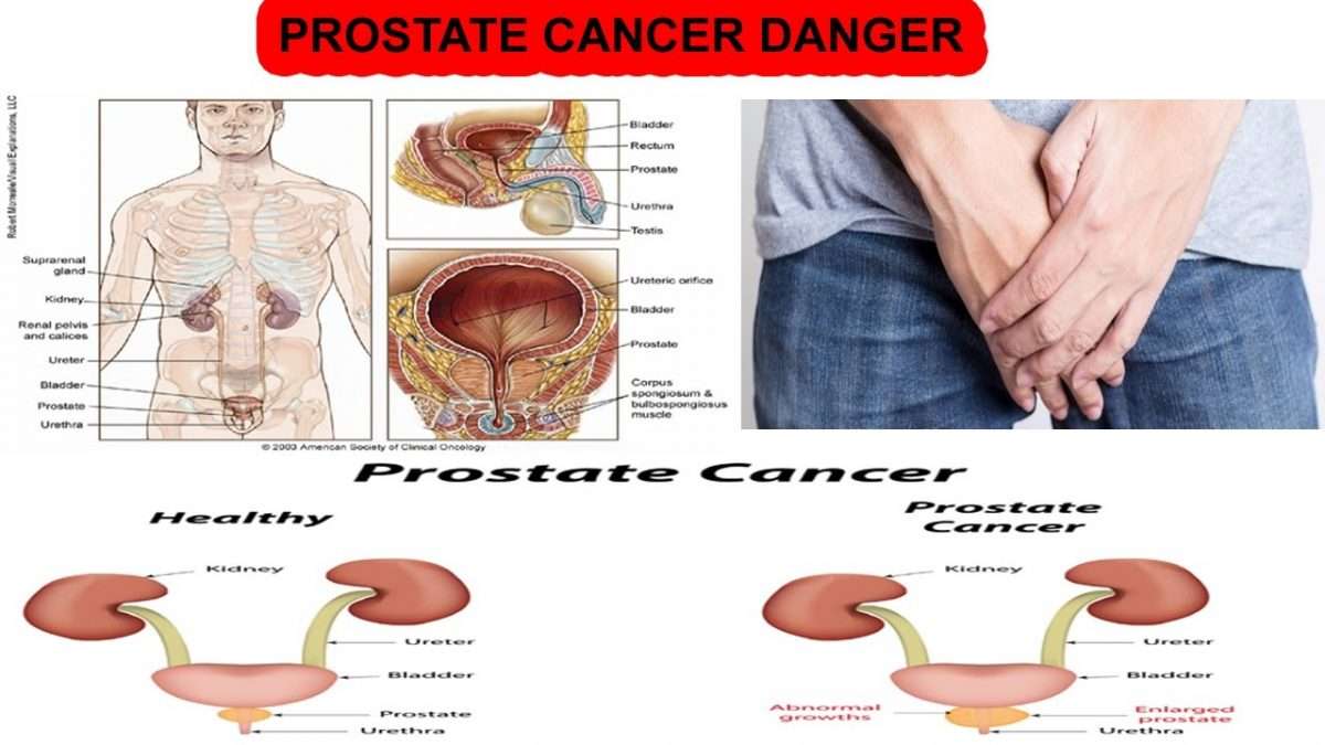 How To Know If Prostate Cancer Spread : Movember spreads prostate ...