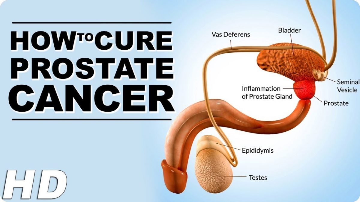 How To Slow/Cure Down Prostate Cancer Naturally At Home