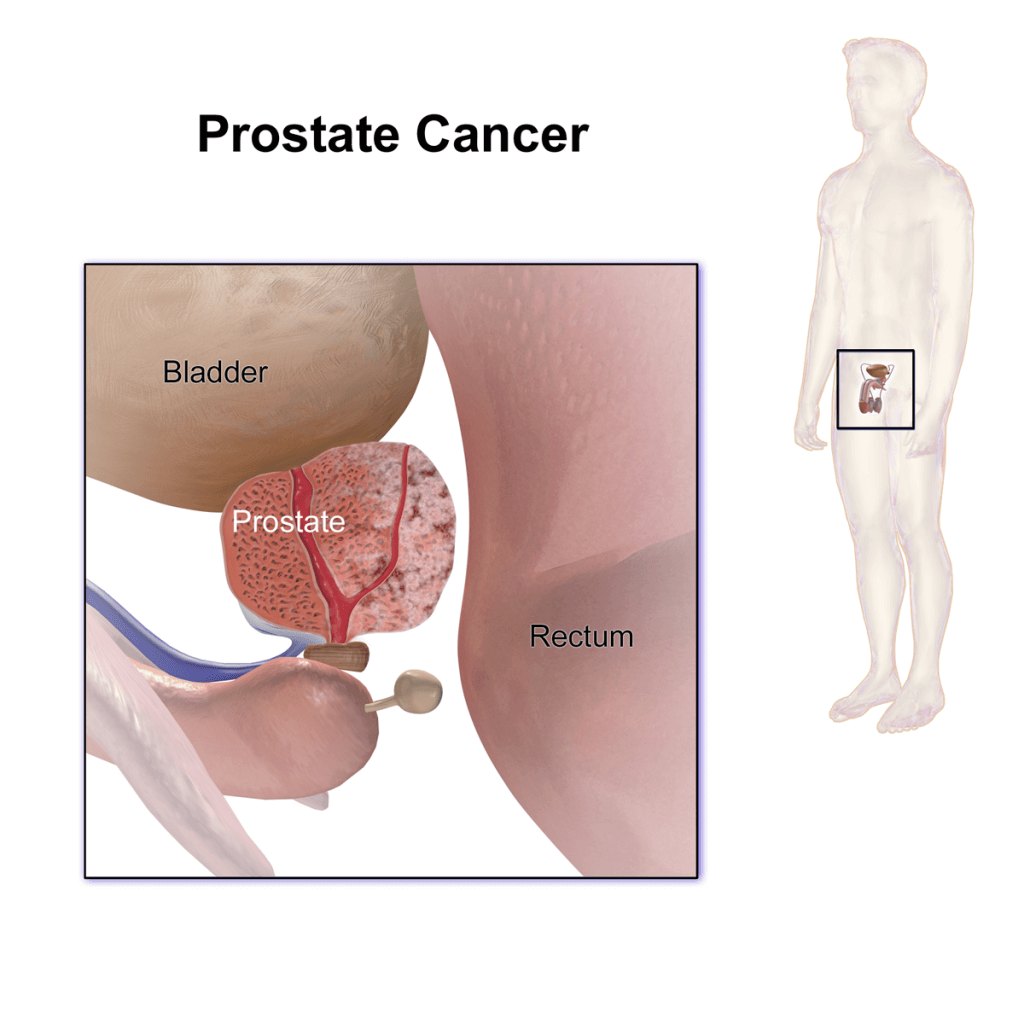 If You Have Prostate Cancer Do They Remove Your Prostate ...
