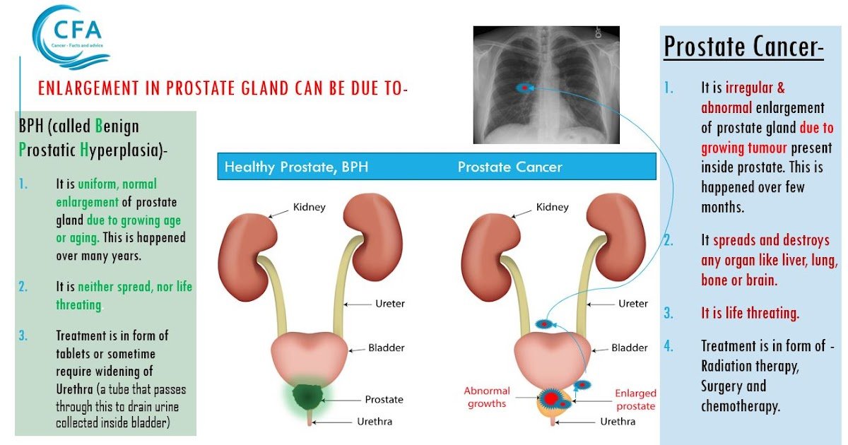 Is every enlargement of Prostate gland due to cancer or ...