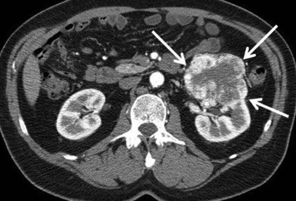 Is it possible that repeated CT scans of the kidneys ...