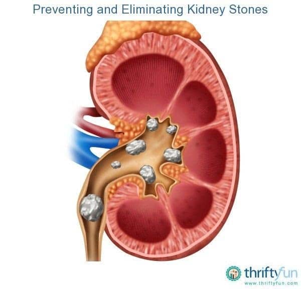 Kidney Stones Cause Prostate Problems