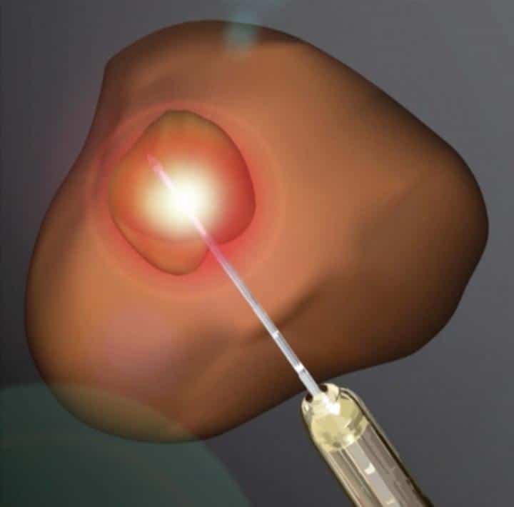 Laser ablation becomes increasingly viable tr