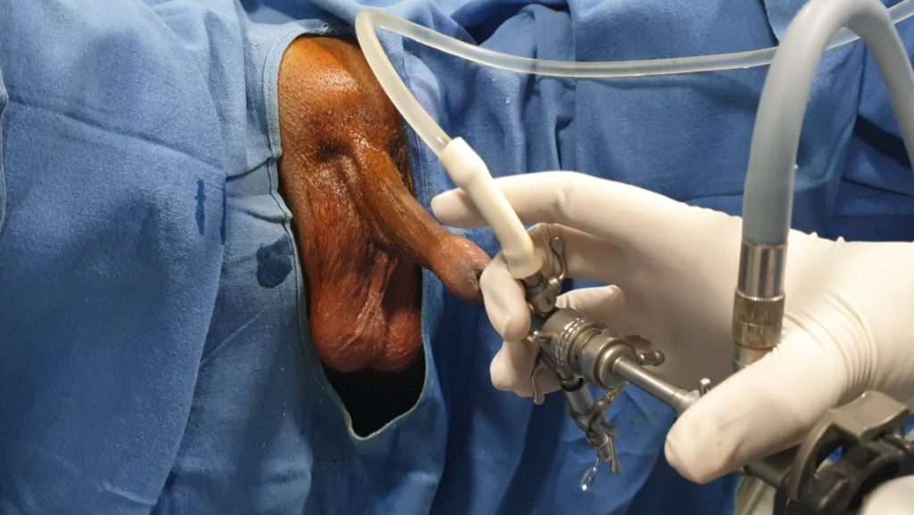 Latest and Painless Surgery for Enlarged Prostate with ...