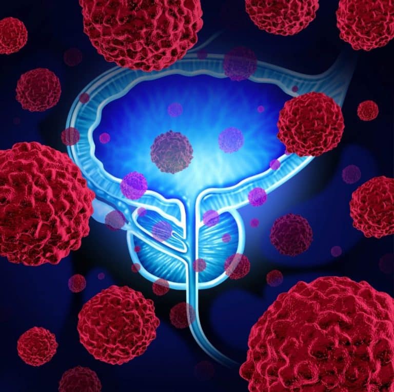 Liquid Biopsy Test Helping Select People with Advanced Prostate Cancer ...