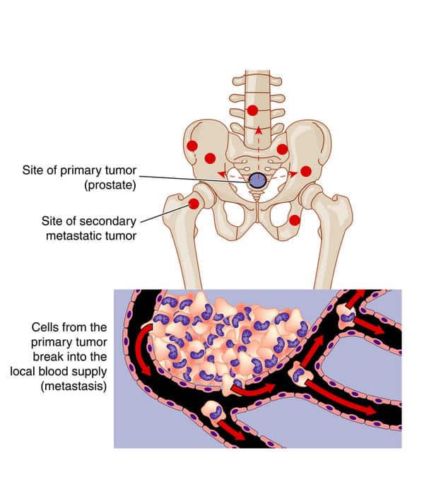 Medical prognosis for cancer in spine lung and liver