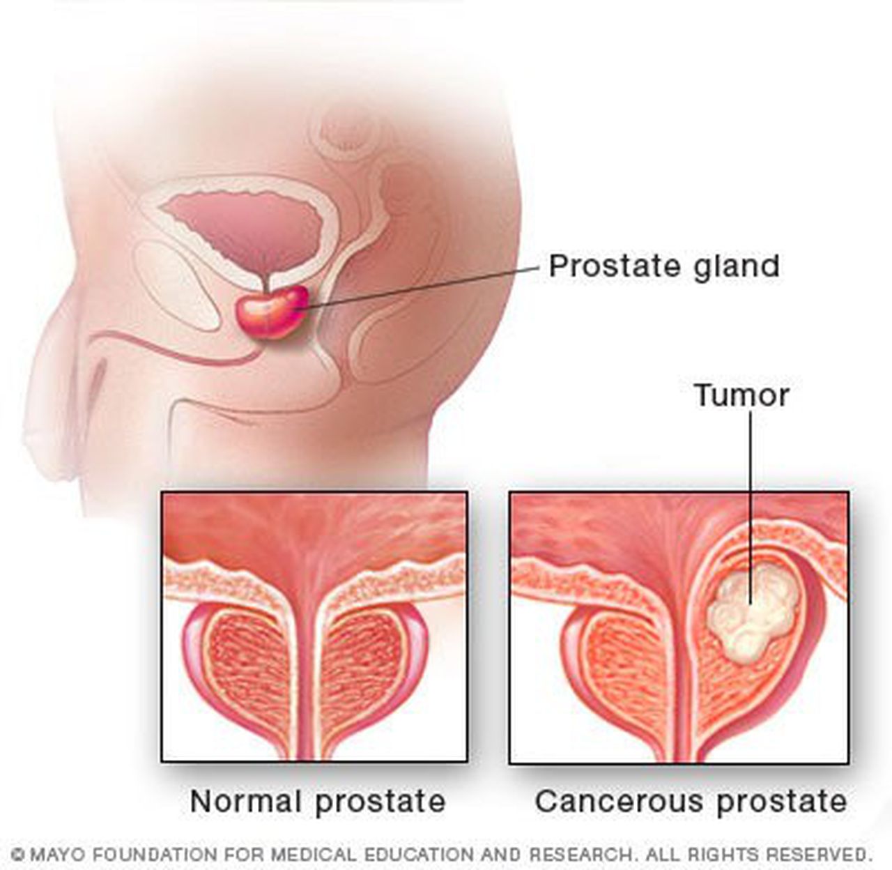 Men should not ignore signs, symptoms of prostate cancer ...
