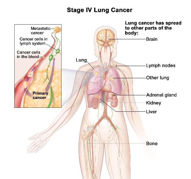 Metastatic Lung Cancer: Symptom, Diagnosis and Treatment ...