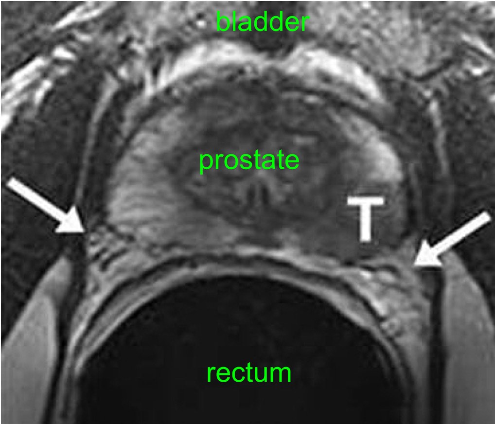 MRI scan of prostate cancer