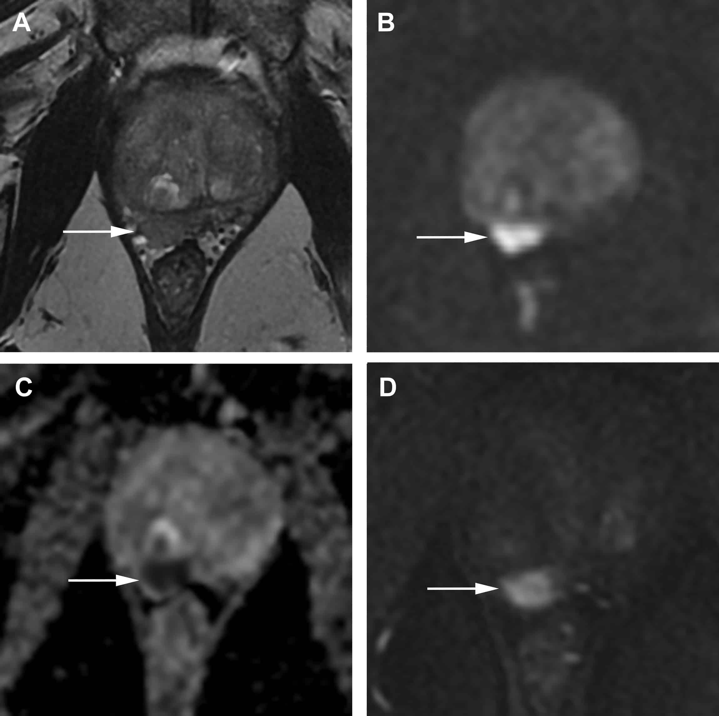 Multiparametric MR imaging of the Prostate