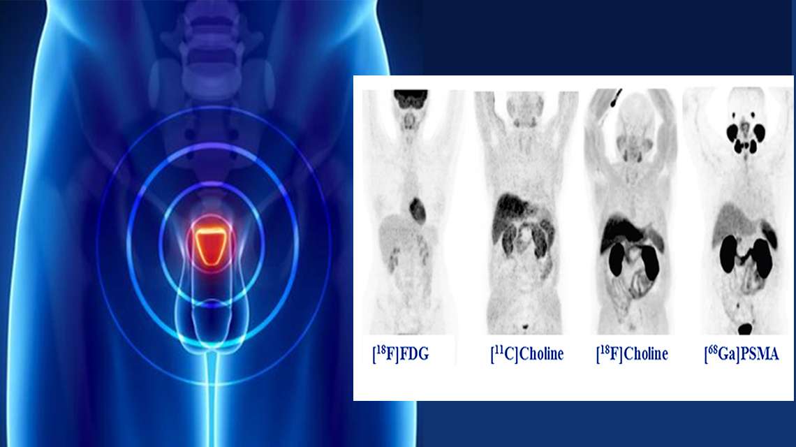NEW CRP: Use of PETCT with Gallium