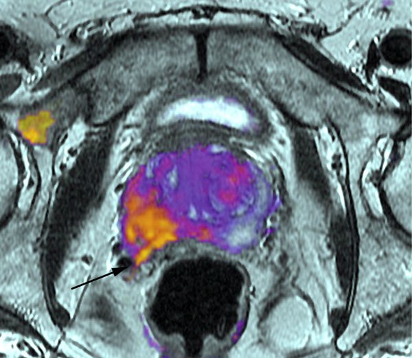 New Imaging Technique for Improved Prostate Cancer ...