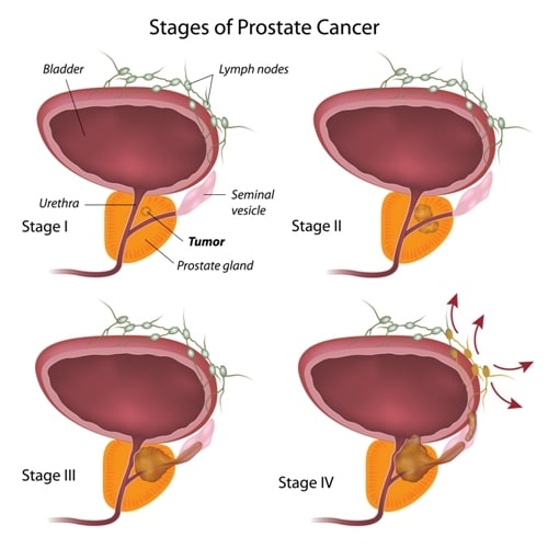 New Target to Fight Prostate Cancer Progression Found