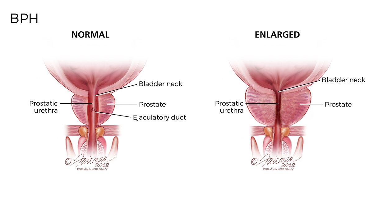 Normal and Enlarged Prostate in 2020