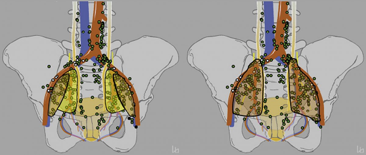 Pelvic Nodal Radiotherapy in Patients With Unfavorable Intermediate and ...