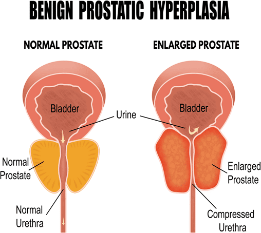 Prostate Artery Embolization Side Effects