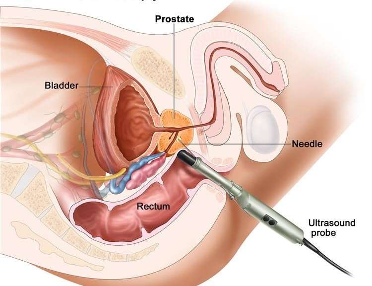 Prostate Biopsy Alternatives and Cancer Treatment Options ...