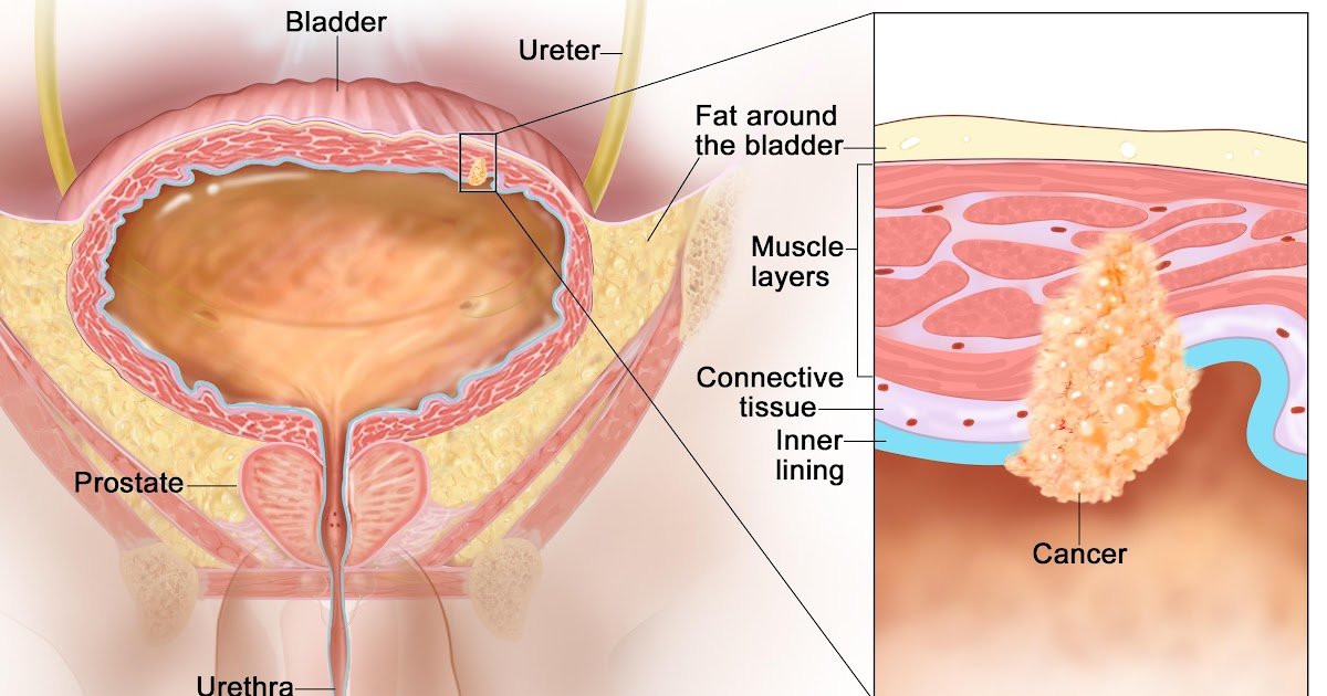Prostate Biopsy most cancers unfold