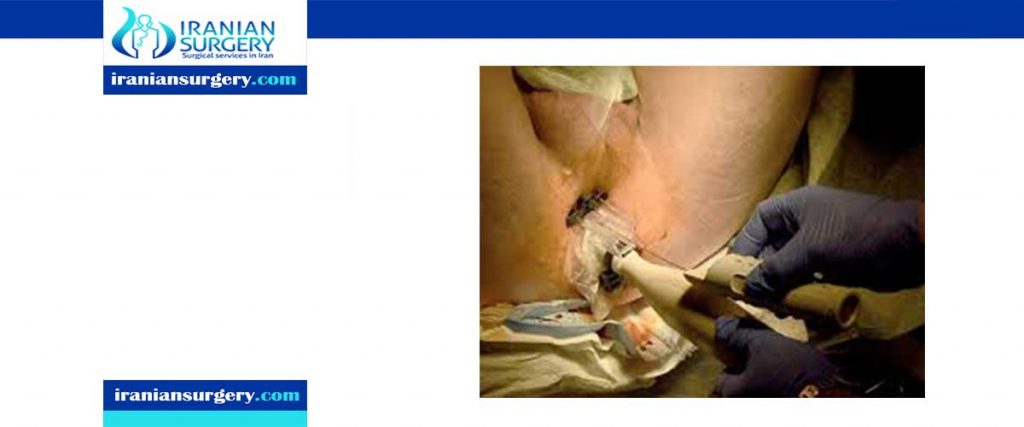 prostate biopsy procedure video