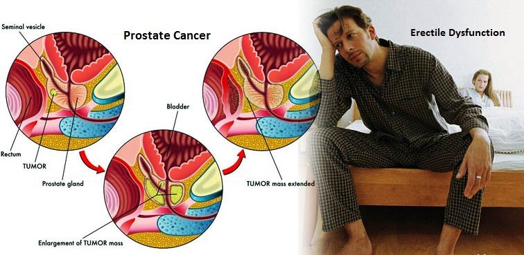 Prostate Cancer and Erectile Dysfunction