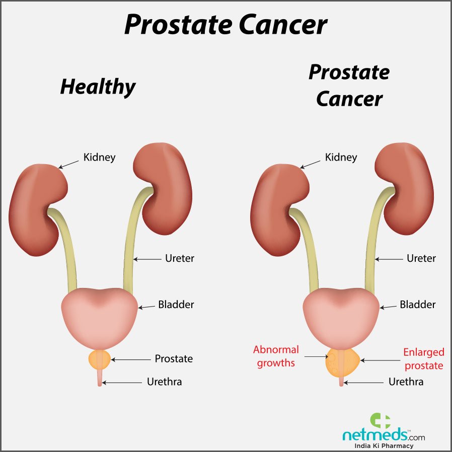 Prostate Cancer: Causes, Symptoms And Treatment