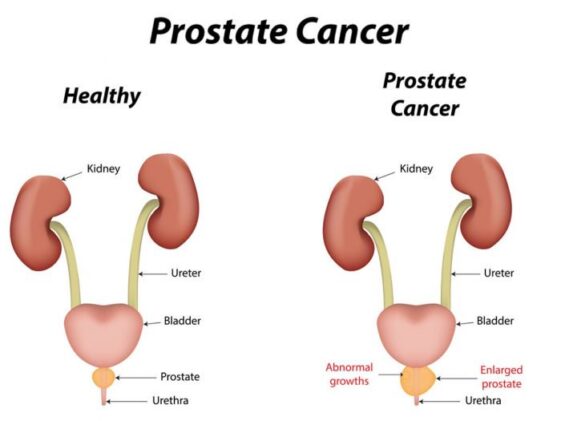 Prostate Cancer: Causes, Symptoms and Treatment ...