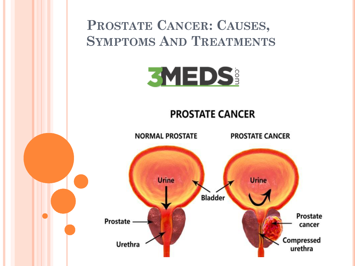 Prostate Cancer Causes, Symptoms And Treatments