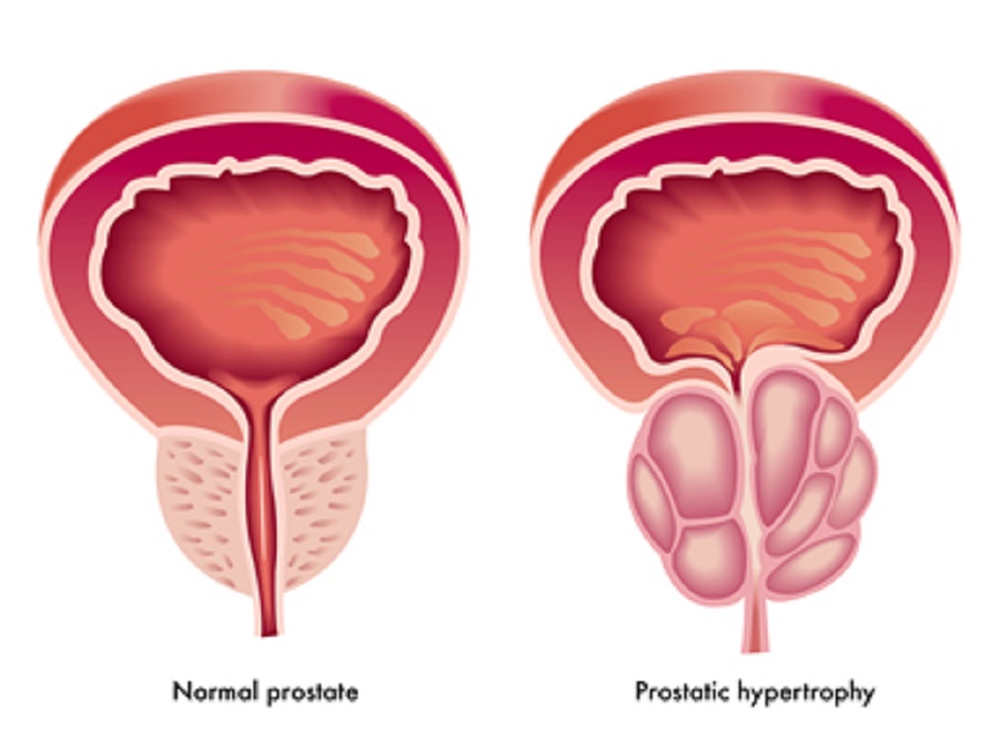 Prostate Cancer, Causes, Symptoms, Diagnosis and Treatment ...