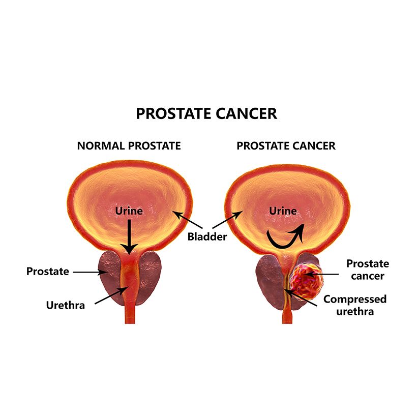 Prostate Cancer Diagnosis &  Treatment