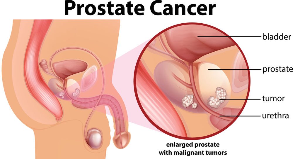 Prostate Cancer: Do You Have to Have a Rectal Exam?