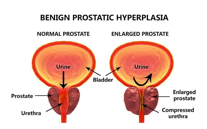 Prostate Cancer Overview: Signs, Symptoms, Screening, and Treatment